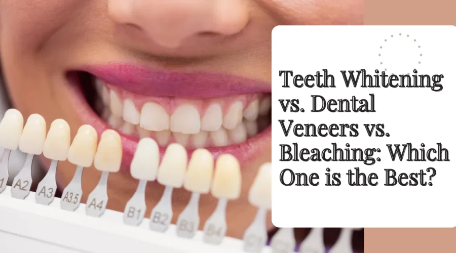 Teeth Whitening vs. Dental Veneers vs. Bleaching