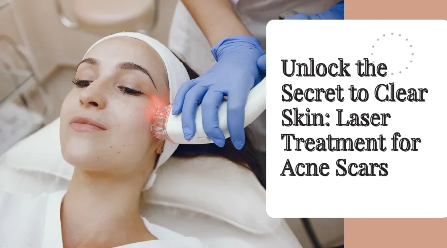 Unlock the Secret to Clear Skin: Laser Treatment for Acne Scars