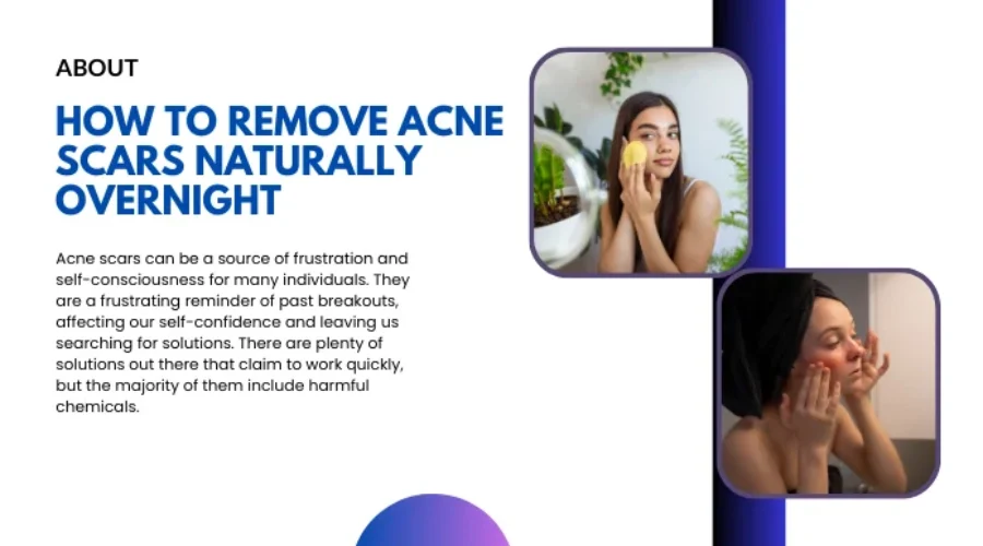 How to Remove Acne Scars Naturally Overnight